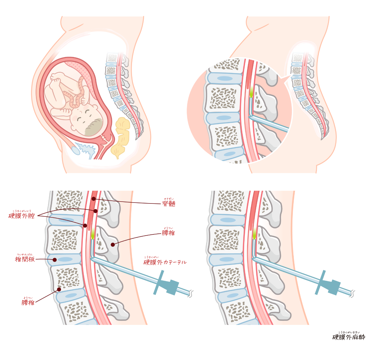 無痛分娩の麻酔方法