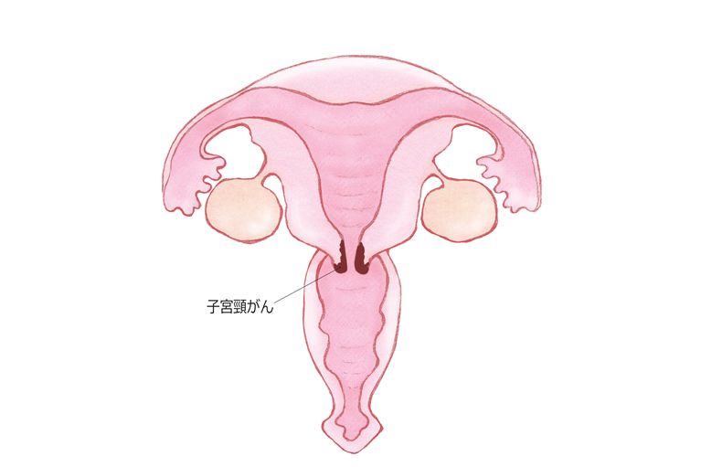 子宮頸がんとは？